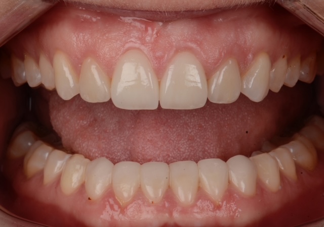 All-Ceramic Restoration